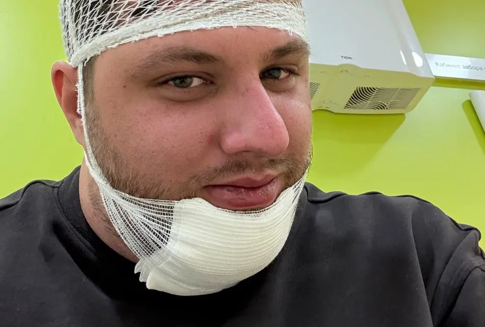 SQreen упал с мотоцикла: "Ничего серьезного, рассек область чуть выше подбородка"