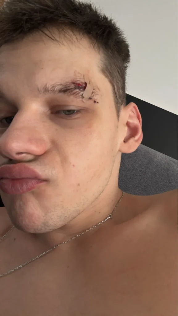 «С Новым годом, ублюдки». Frozen опубликовал фото с рассеченной бровью