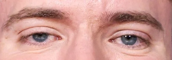 MrBeast: &laquo;Я практически слеп на правый глаз&raquo;